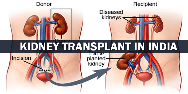 4 Kidney Transplant In One Patient AIIMS Delhi